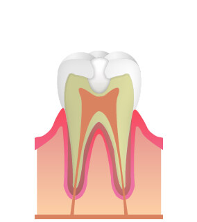 最新のMTAセメント充填法で歯の神経を残す治療を行っています